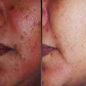 Skin Brightening Injection Therapy